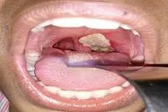 Diphtheria Outbreak Claims Two Lives in Abuja as FCTA Intensifies Response